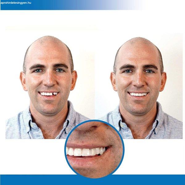 Instant smile - fogsor javító készlet vészhelyzet esetére - ideiglenes
fogpótlás készítő (BBM)