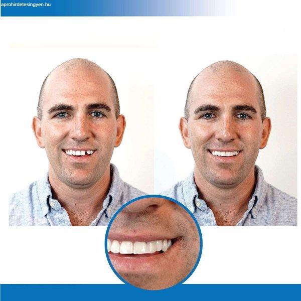 Instant smile - fogsor javító készlet vészhelyzet
esetére - ideiglenes fogpótlás készítő (BBM)