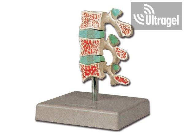 Anatómiai modell CSONTRITKULÁS / OSTEOPORÓZIS
